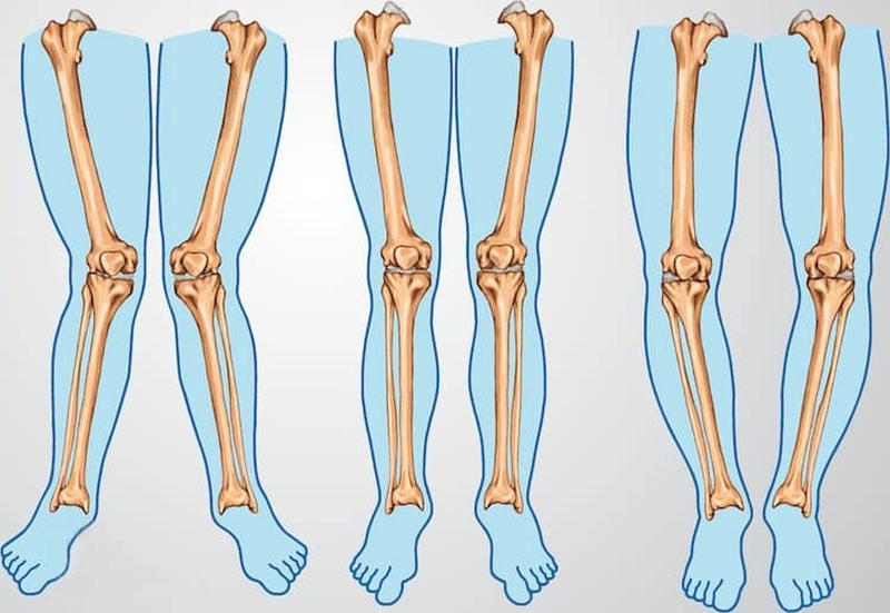 Để chữa triệt để tình trạng chân vòng kiềng, các bài tập cần được duy trì đều đặn mỗi ngày