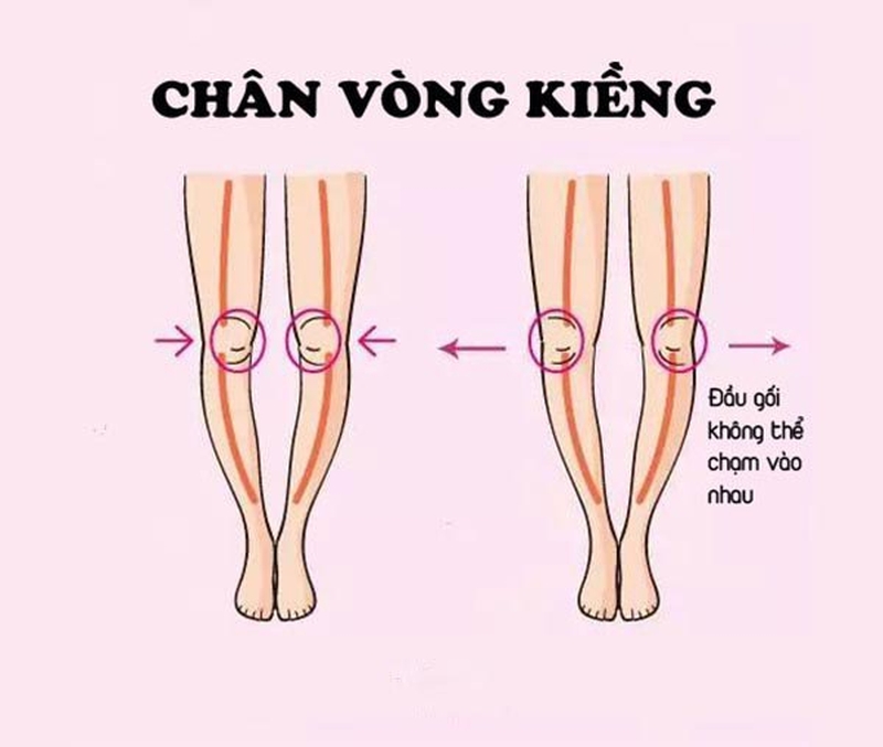 Chân vòng kiềng là tình trạng hai chân không thể khép sát lại