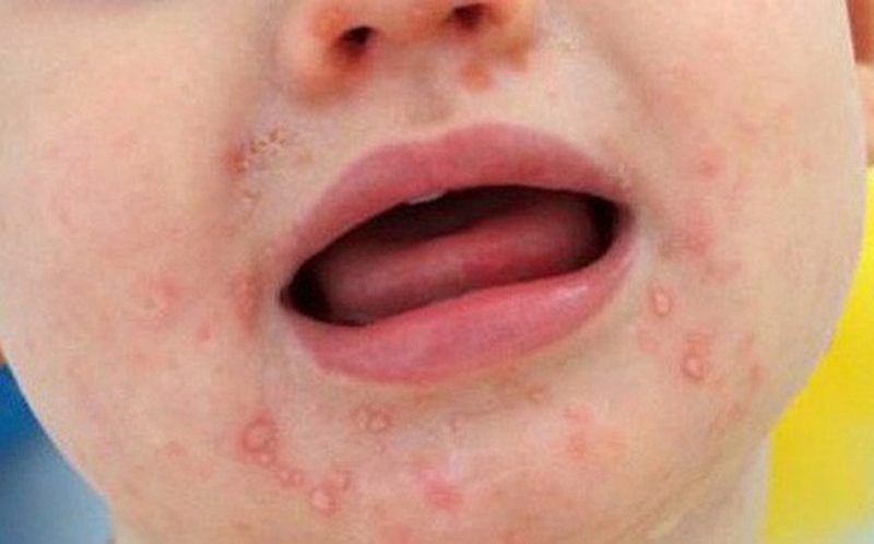 Top 5 bệnh thường gặp ở miệng nguy hiểm bạn cần cảnh giác