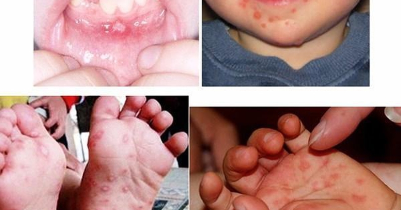 Top 5 bí quyết giúp bé nhanh khỏi bệnh tay chân miệng