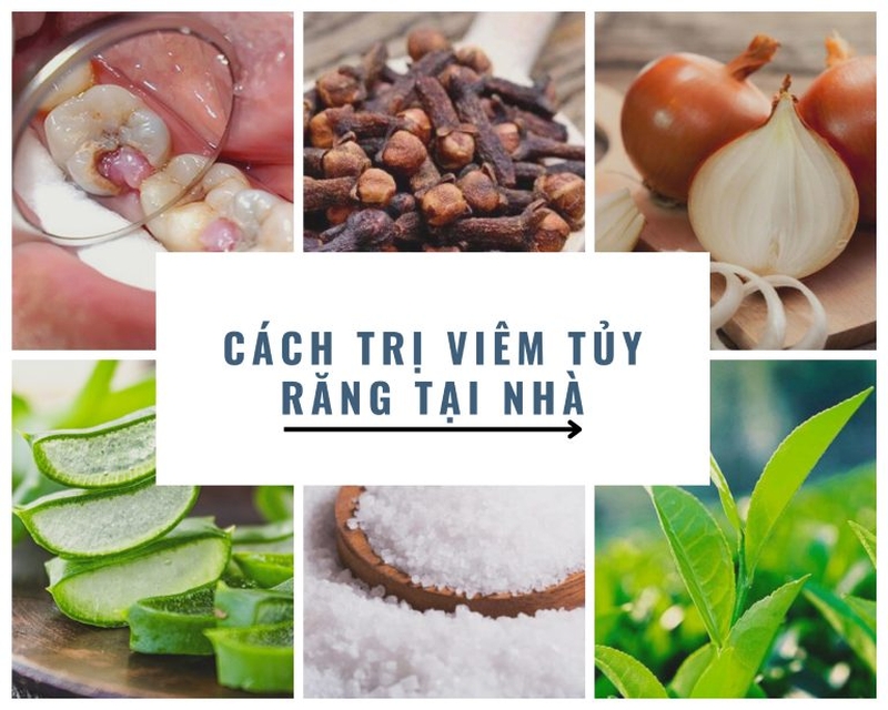 trị viêm tủy răng tại nhà bằng hành tây