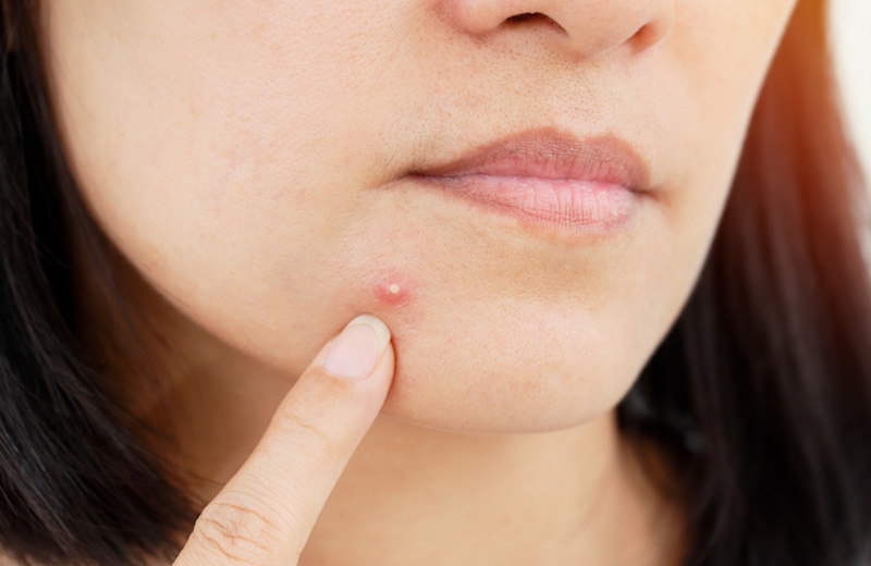 Bật mí những loại kem trị mụn bọc tốt nhất trên thị trường hiện nay 3