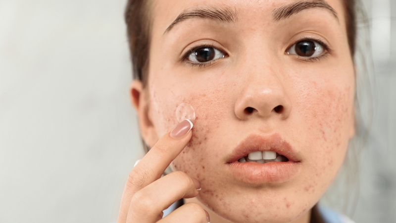 Thói quen sờ hoặc bóc kiểm tra liên tục có thể làm giảm khả năng bảo vệ vùng da có mụn
