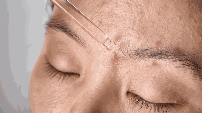 Top 5 serum trị mụn hiệu quả được nhiều người tin dùng 1