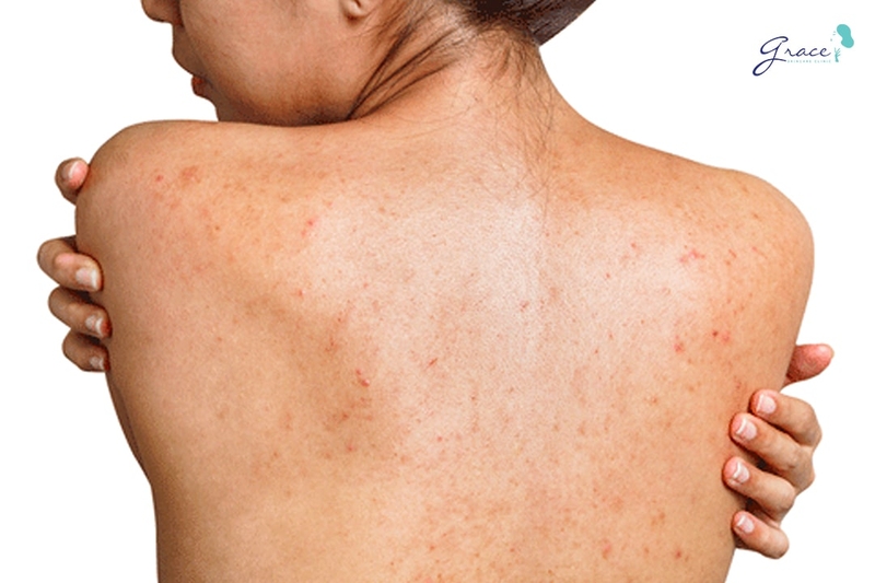 Top 5 sữa tắm trị mụn lưng cho bà bầu nhất định phải thử 1