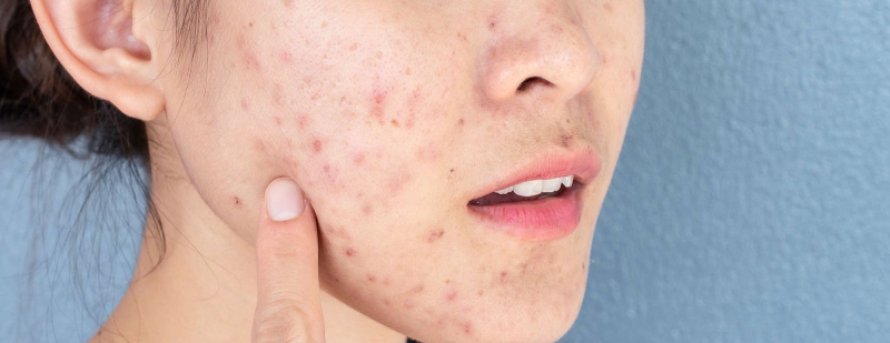 Top 6 thuốc uống trị mụn nội tiết tốt nhất hiện nay 1