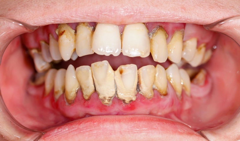 Kem đánh răng cho người niềng răng: Kin Gingival