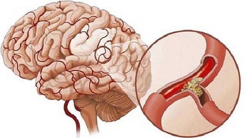 TPA là gì? Tầm quan trọng của TPA trong điều trị đột quỵ 2