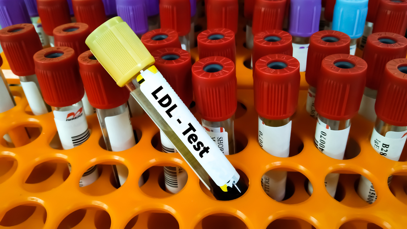 Tiêu thụ nhiều sữa đặc và kem béo có thể làm tăng cholesterol LDL trong máu