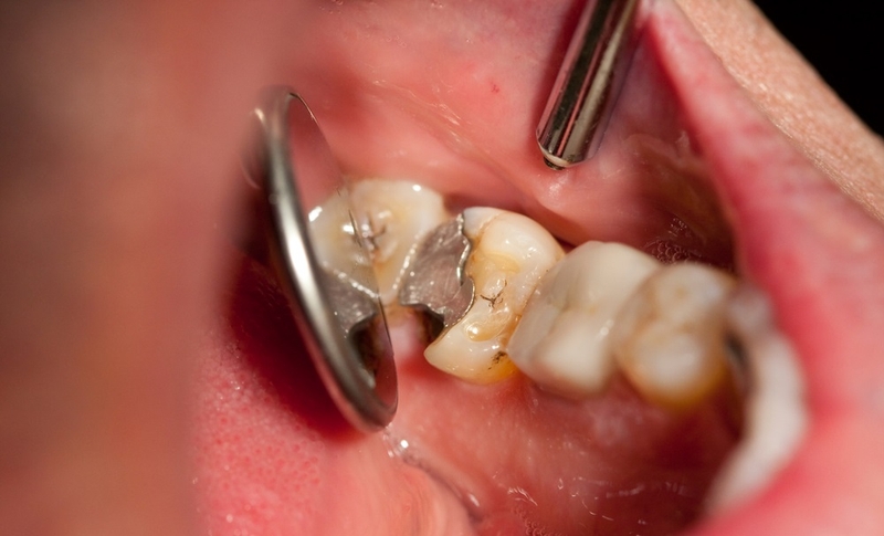 Khi nào cần trám lại răng đã trám và lưu ý khi thực hiện 1