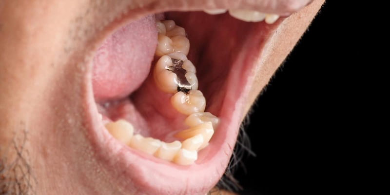 Trám răng bằng Amalgam có độc không? Ưu và nhược điểm khi trám răng bằng Amalgam 1