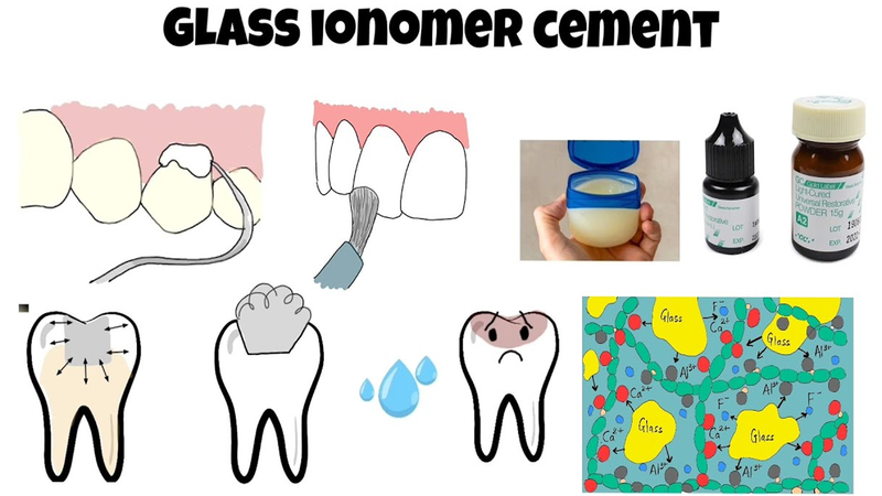 Quy trình trám răng bằng công nghệ Glass Ionomer Cement