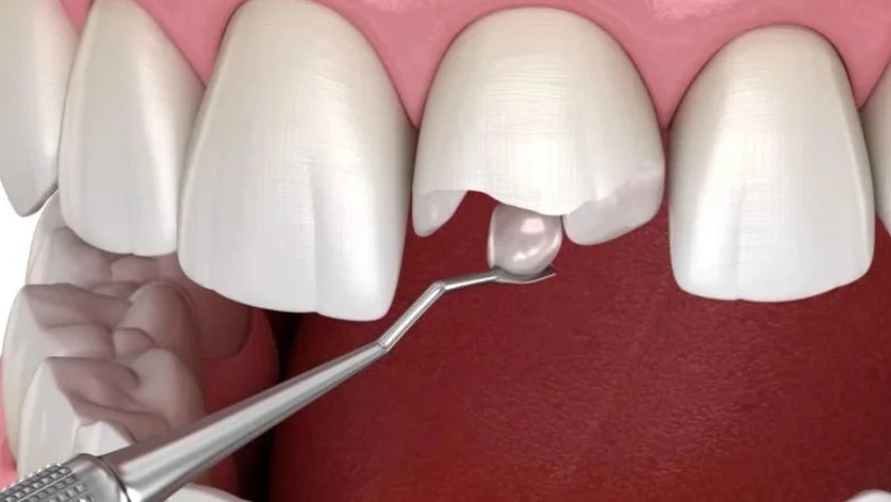 Trám răng cửa bị gãy có đau không? Những điều bạn cần biết 2