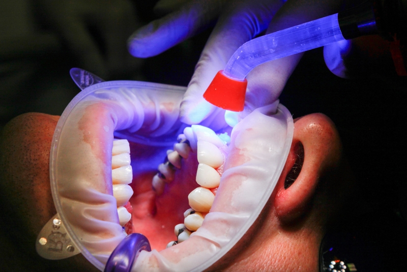 Trám răng là gì? Trám răng có cần chích thuốc tê không 3