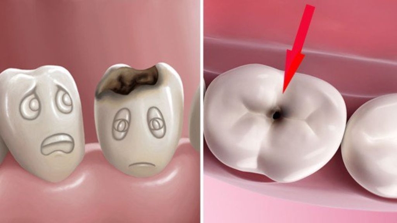 Trám răng rồi có tẩy trắng được không? Chăm sóc thế nào? 1