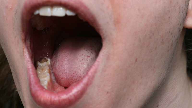 Trám răng sâu lỗ to bao nhiêu tiền? Các yếu tố ảnh hưởng đến chi phí 1