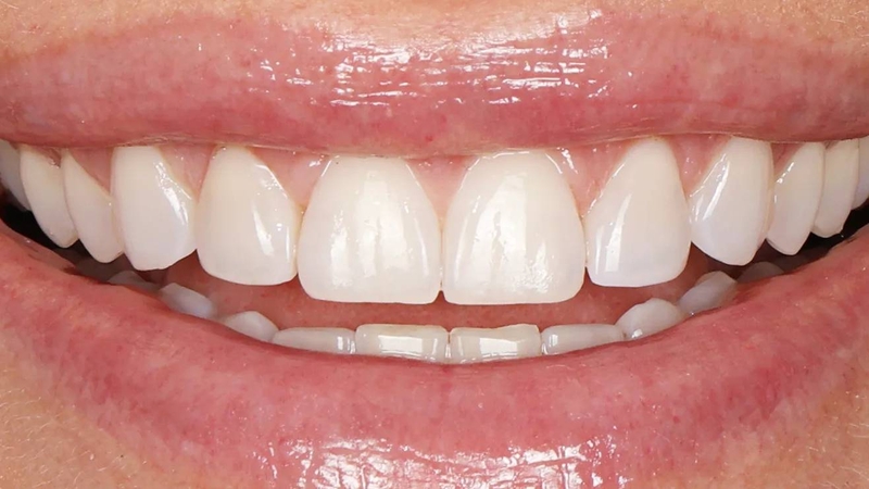 Trám răng sâu lỗ to bao nhiêu tiền? Các yếu tố ảnh hưởng đến chi phí 3