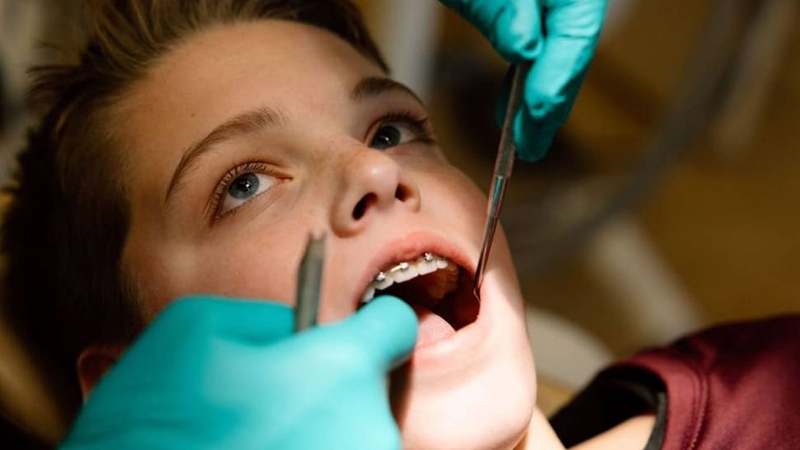 Trám răng sâu lỗ to bao nhiêu tiền? Các yếu tố ảnh hưởng đến chi phí 4