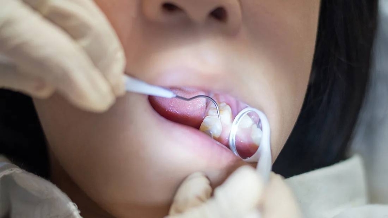 Trám răng sâu lỗ to bao nhiêu tiền? Các yếu tố ảnh hưởng đến chi phí 5