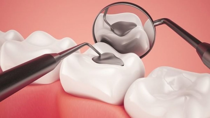 Trám răng thẩm mỹ: Đặc điểm và những lưu ý khi thực hiện! 1