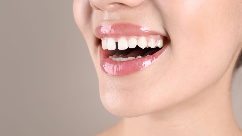 Mỗi phương pháp phù hợp với từng tình trạng răng thưa khác nhau