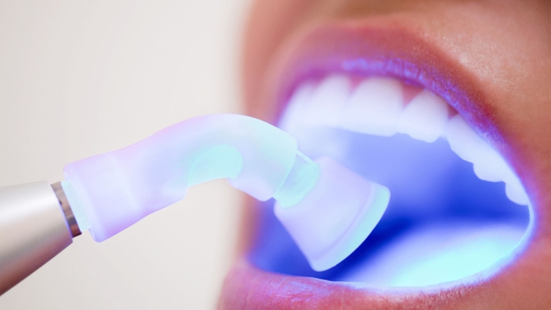 Trám răng là giải pháp nhanh chóng cho các khe thưa nhỏ
