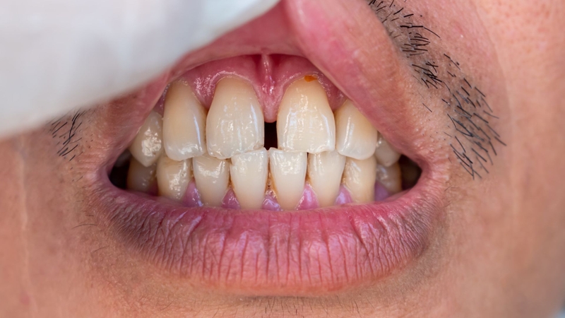 Nha sĩ sẽ tư vấn phương pháp phù hợp sau khi thăm khám