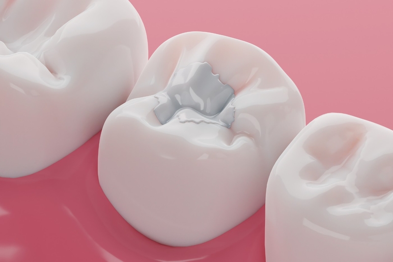 Răng sâu đục lỗ có thể khắc phục bằng hàn trám răng