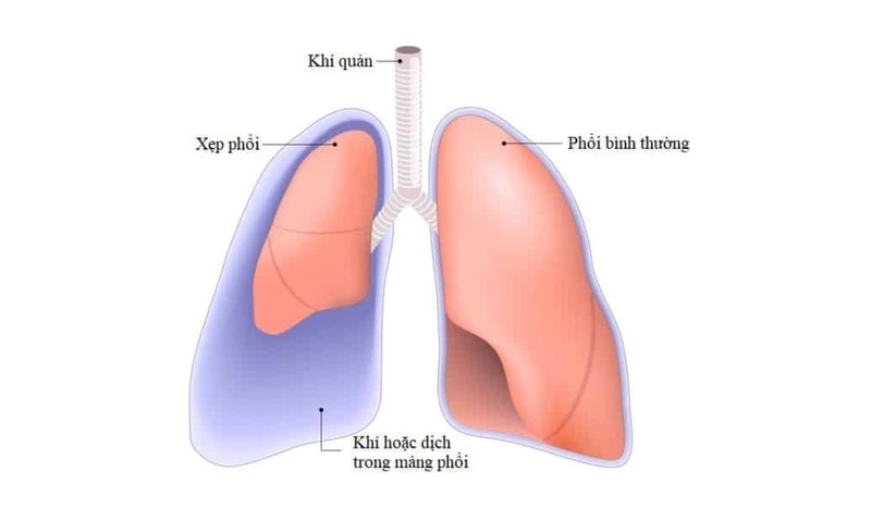 Tràn dịch màng phổi ác tính thường có nguyên nhân do bệnh ung thư