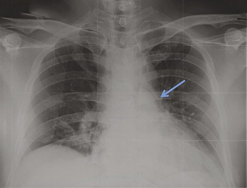 tràn khí trung thất 2