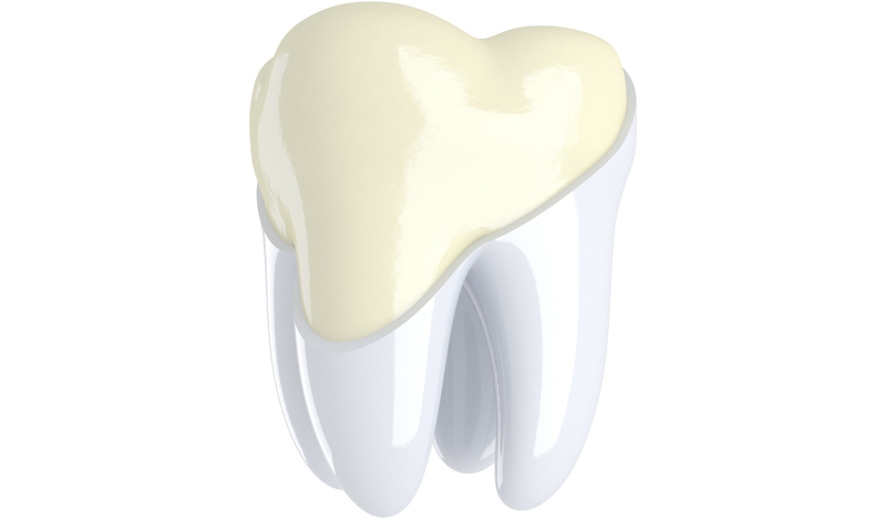Tráng men răng giúp răng trắng, đều màu hơn