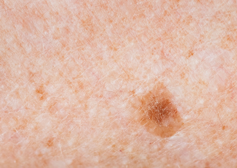 Tránh nắng để giảm bị đồi mồi sau này1