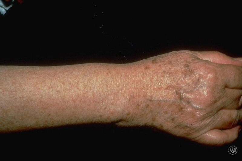 Tránh nắng để giảm bị đồi mồi sau này4