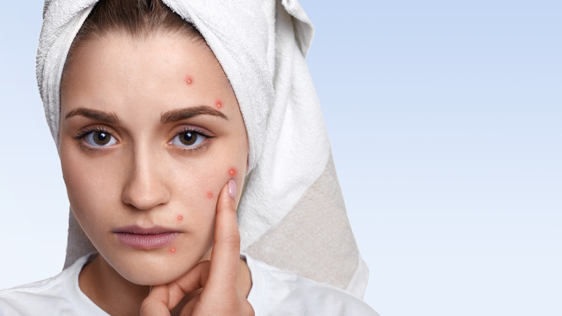 Tránh xa 7 sai lầm sau khi điều trị mụn trứng cá tuổi dậy thì 4