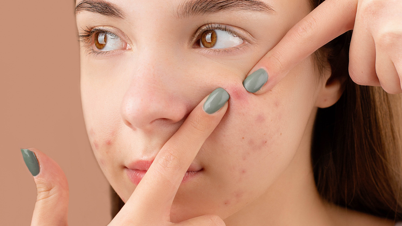 Tránh xa 7 sai lầm sau khi điều trị mụn trứng cá tuổi dậy thì 2