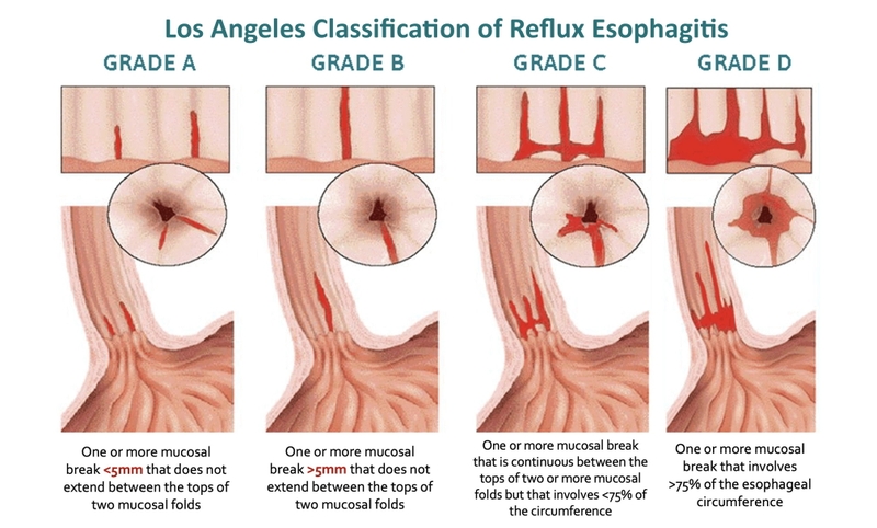 Trào ngược dạ dày độ b: Triệu chứng, nguyên nhân và cách điều trị 2