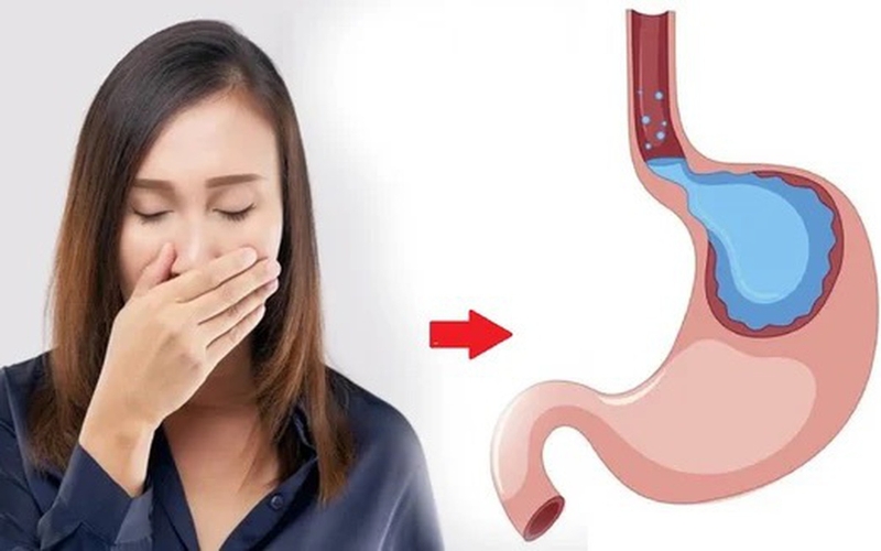 Trào ngược dạ dày độ b: Triệu chứng, nguyên nhân và cách điều trị 4