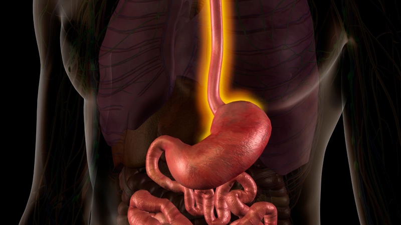 Trào ngược dạ dày kèm ho về đêm có thể làm tổn thương thực quản gây viêm loét