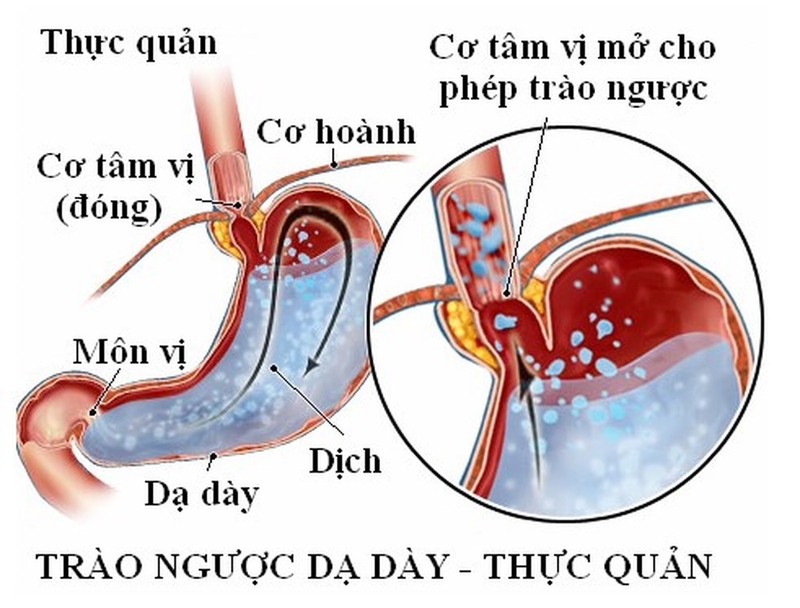Trào ngược dạ dày gây rối loạn nhịp tim 1