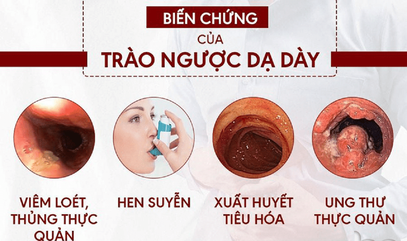 Trào ngược dạ dày là gì? Các cấp độ trào ngược dạ dày bạn cần biết 1