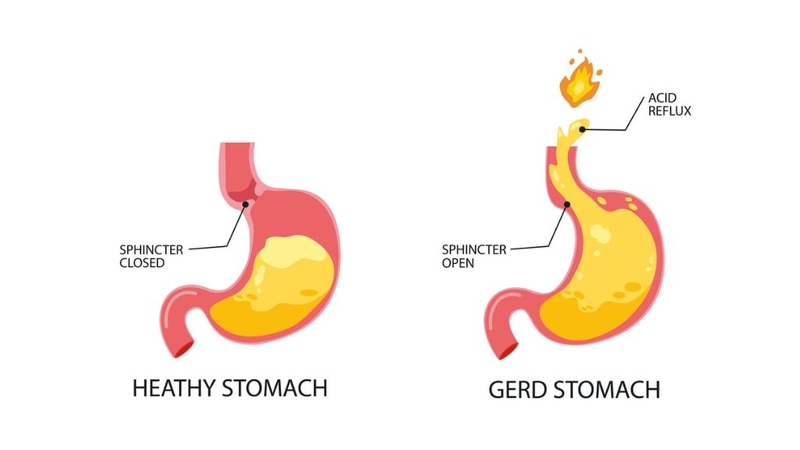 trao-nguoc-da-day-nong-co-hieu-ro-de-khac-phuc 1