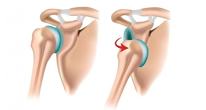 Trật khớp có tự khỏi được không? -1