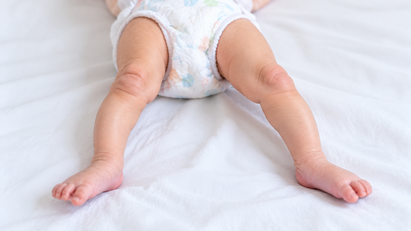 Trật khớp gối bẩm sinh là dị tật hiếm gặp khiến khớp gối trẻ sơ sinh duỗi quá mức