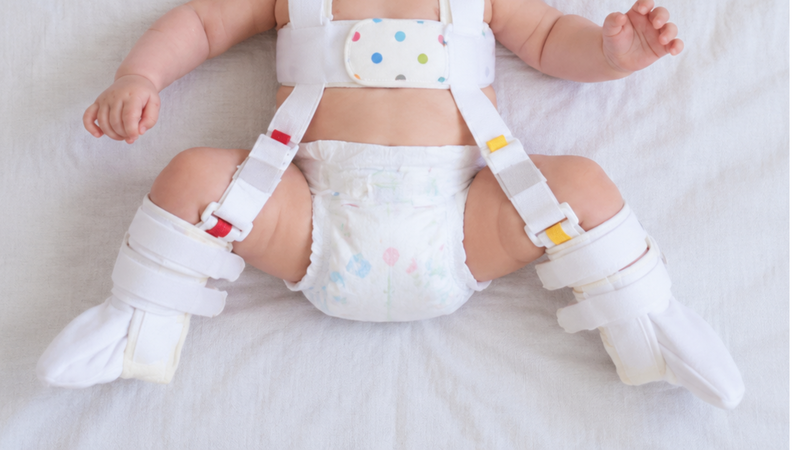 Chân của trẻ không thể gập lại bình thường mà bị ưỡn cong về phía trước một cách bất thường