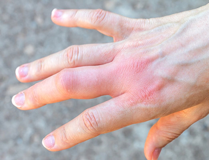 Trật khớp ngón tay là gì