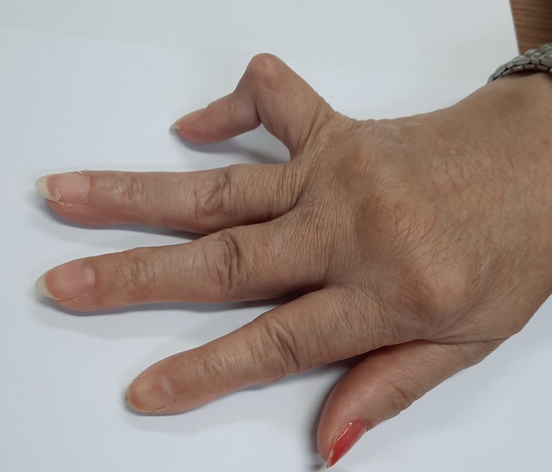 Trật khớp tay bao gồm những loại nào? 3