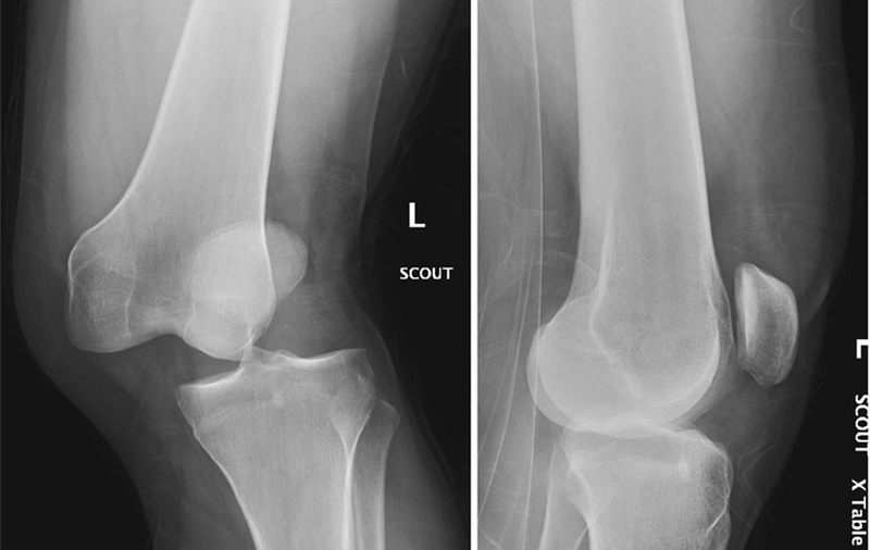 Trật xương bánh chè và những điều cần lưu ý 2