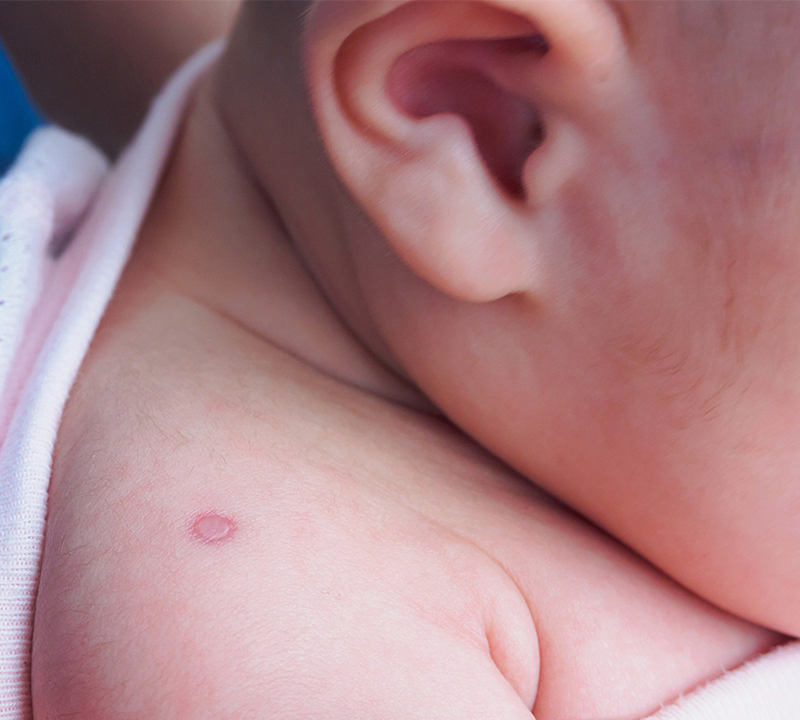 Trẻ 2 tháng tuổi có tiêm phòng lao được không? 2