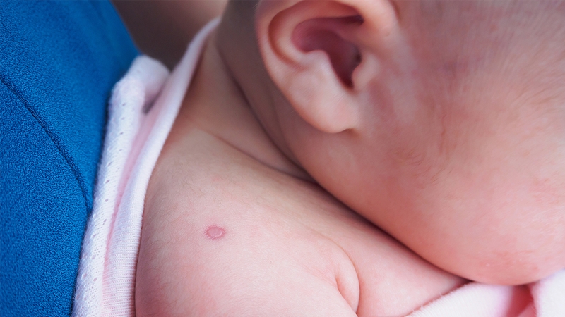 Trẻ 4 tháng tuổi có tiêm phòng lao được không? 3