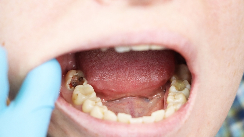 Trẻ 7 tuổi bị sâu răng hàm phải làm sao? 1